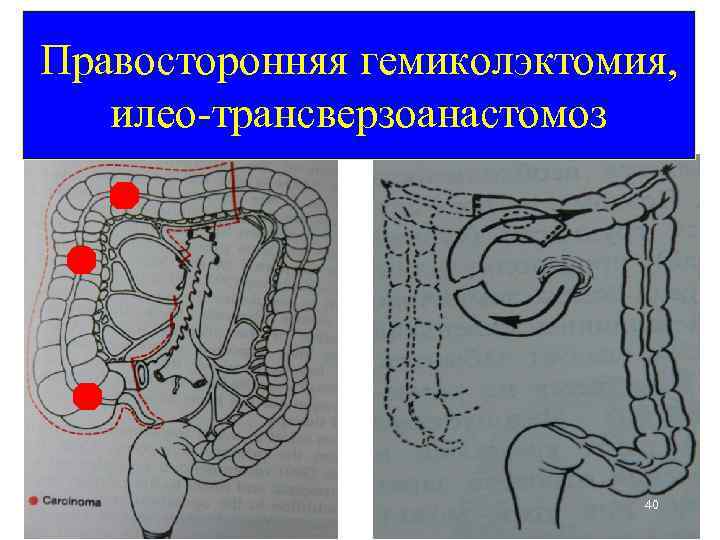 Кишечная непроходимость карта смп