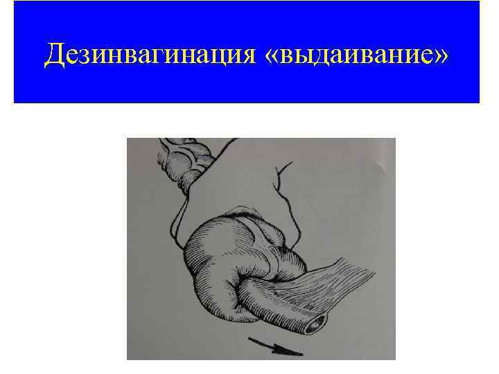 Дезинвагинация «выдаивание» 42 