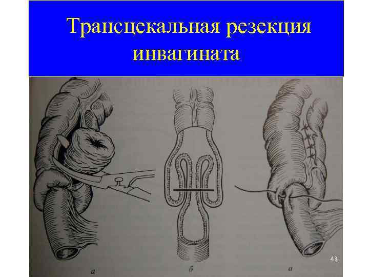 Трансцекальная резекция инвагината 43 