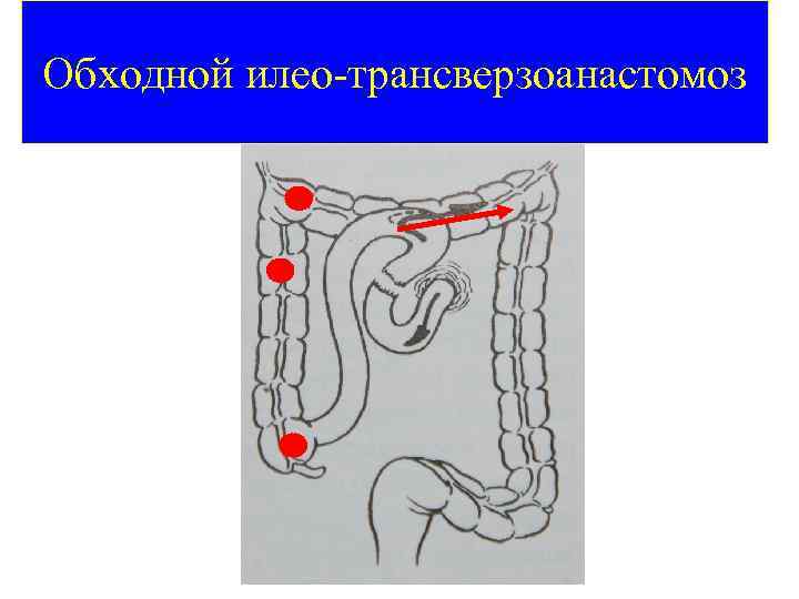 Обходной илео-трансверзоанастомоз 45 