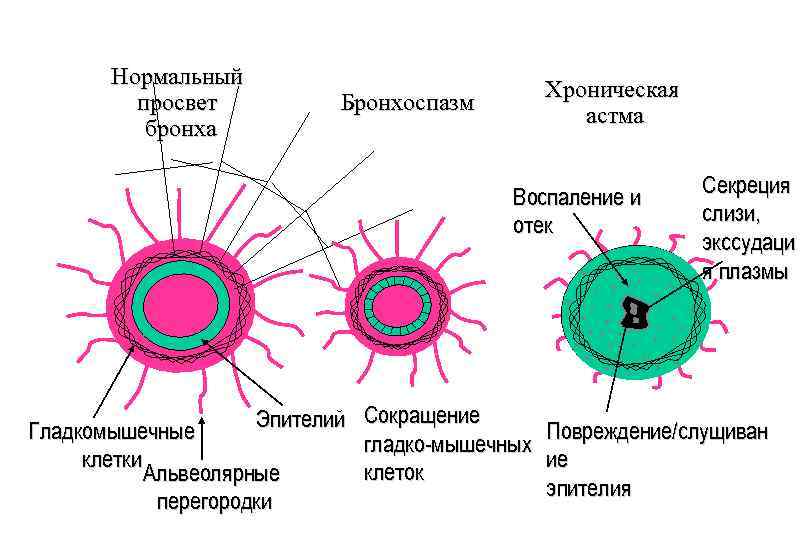 Нормальный просвет бронха Хроническая астма Бронхоспазм Воспаление и отек Эпителий Сокращение Гладкомышечные гладко-мышечных клетки