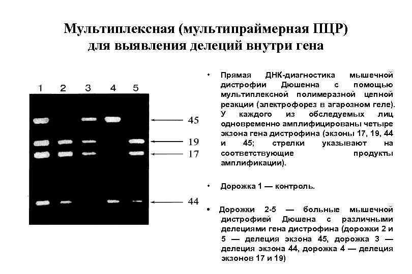 Мультиплексная (мультипраймерная ПЦР) для выявления делеций внутри гена • Прямая ДНК-диагностика мышечной дистрофии Дюшенна