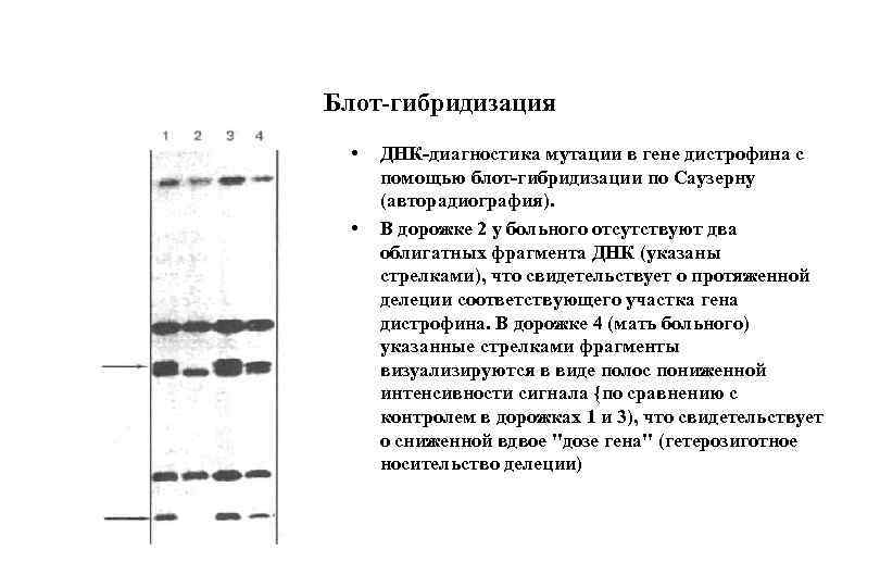 Блот-гибридизация • • ДНК-диагностика мутации в гене дистрофина с помощью блот-гибридизации по Саузерну (авторадиография).