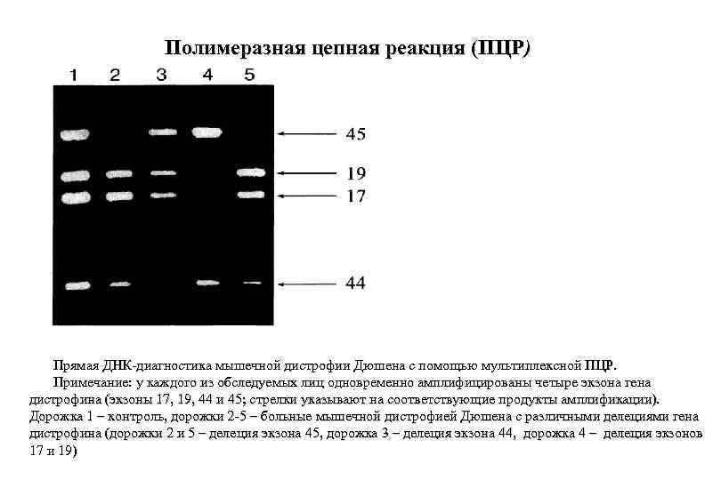 Полимеразная цепная реакция (ПЦР) Прямая ДНК-диагностика мышечной дистрофии Дюшена с помощью мультиплексной ПЦР. Примечание: