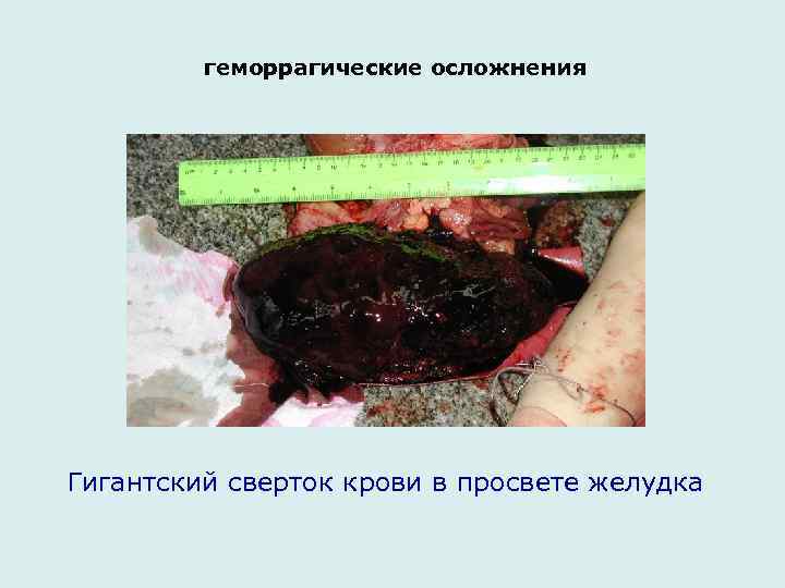  геморрагические осложнения Гигантский сверток крови в просвете желудка 