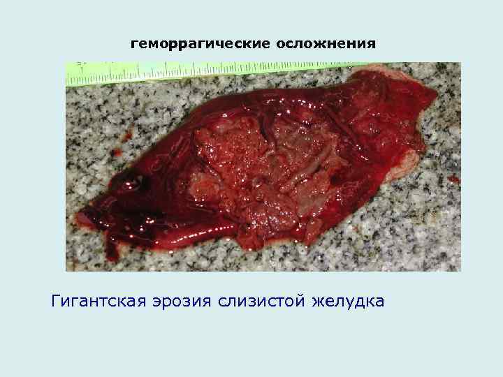  геморрагические осложнения Гигантская эрозия слизистой желудка 