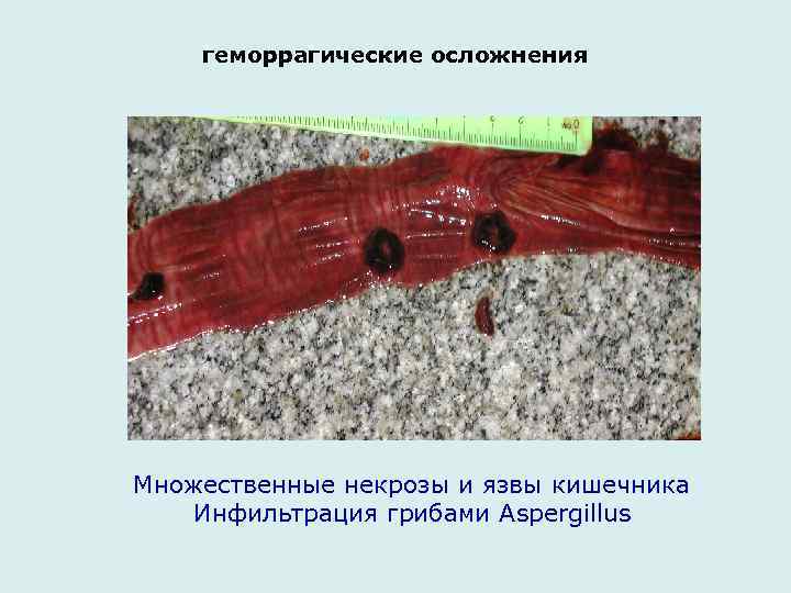 геморрагические осложнения Множественные некрозы и язвы кишечника Инфильтрация грибами Aspergillus 