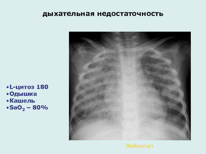 дыхательная недостаточность • L-цитоз 180 • Одышка • Кашель • Sa. O 2 –