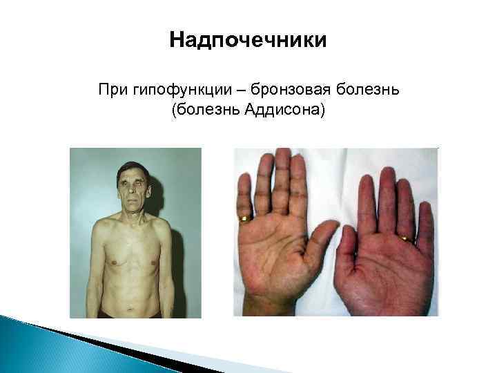 Надпочечники При гипофункции – бронзовая болезнь (болезнь Аддисона) 