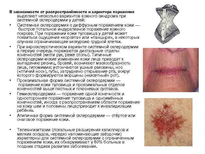 В зависимости от распространённости и характера поражения • • • выделяют несколько вариантов кожного