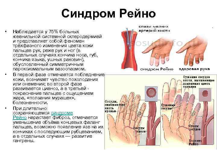 Синдром Рейно • • • Наблюдается у 75% больных ювенильной системной склеродермией и представляет