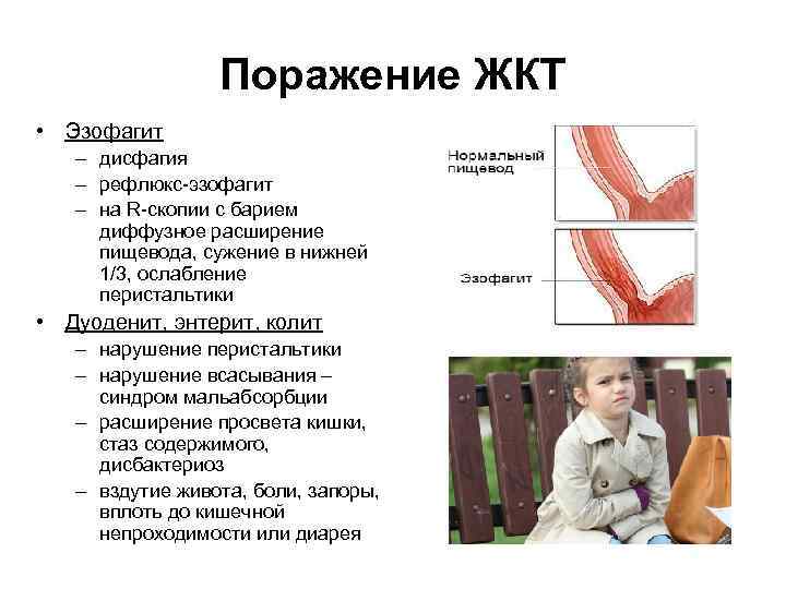 Поражение ЖКТ • Эзофагит – дисфагия – рефлюкс-эзофагит – на R-скопии с барием диффузное