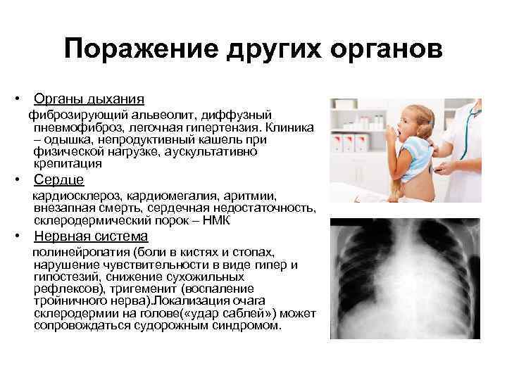 Поражение других органов • Органы дыхания фиброзирующий альвеолит, диффузный пневмофиброз, легочная гипертензия. Клиника –