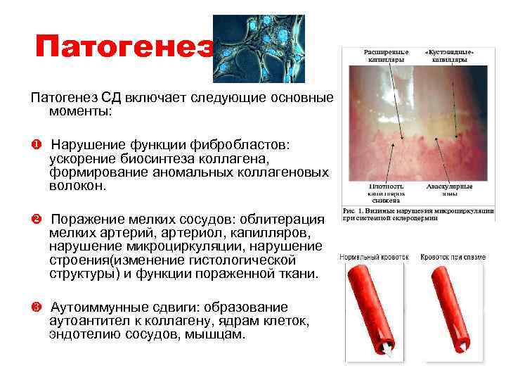 Патогенез СД включает следующие основные моменты: Нарушение функции фибробластов: ускорение биосинтеза коллагена, формирование аномальных