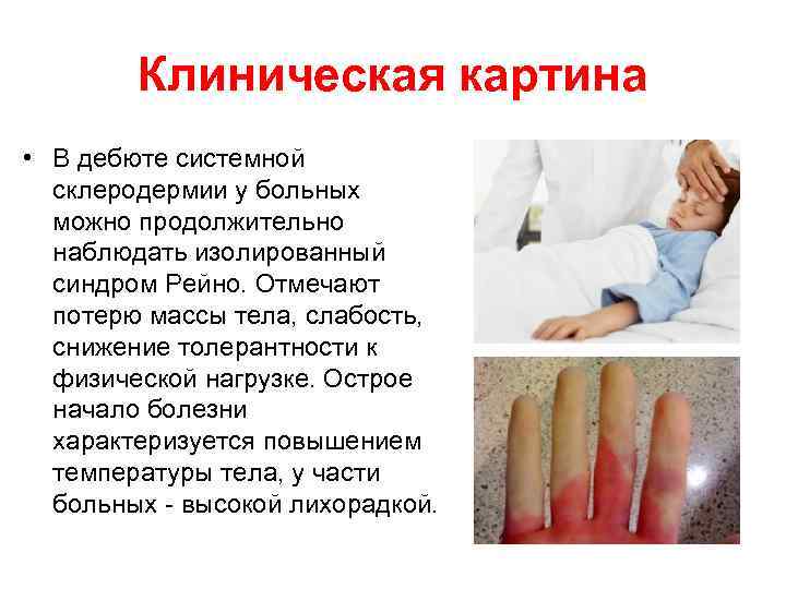 Клиническая картина • В дебюте системной склеродермии у больных можно продолжительно наблюдать изолированный синдром