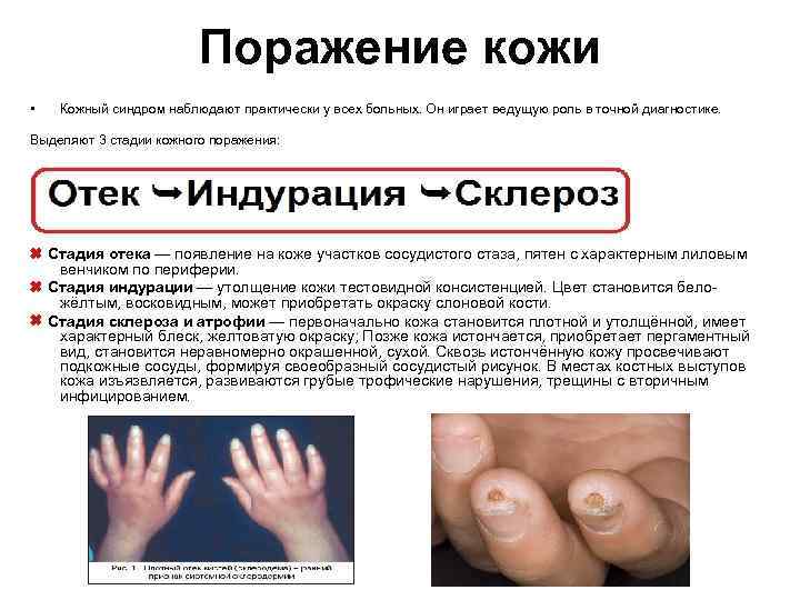 Поражение кожи • Кожный синдром наблюдают практически у всех больных. Он играет ведущую роль