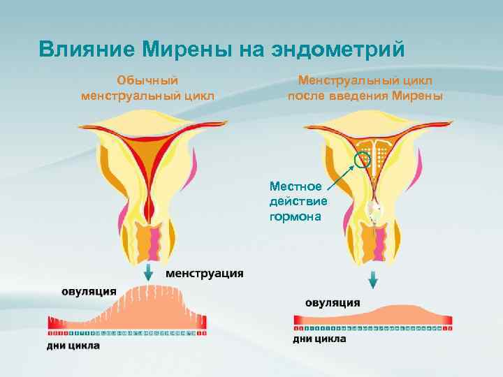Влияние Мирены на эндометрий Обычный менструальный цикл Менструальный цикл после введения Мирены Местное действие