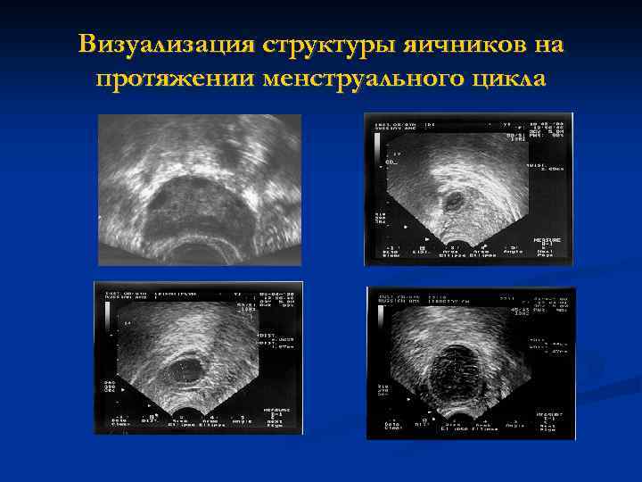 Визуализация структуры яичников на протяжении менструального цикла 
