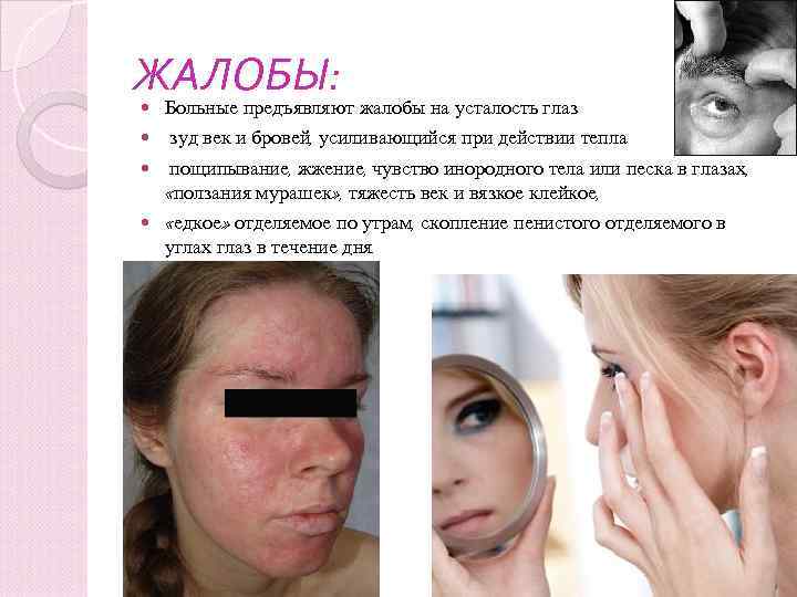 ЖАЛОБЫ: Больные предъявляют жалобы на усталость глаз зуд век и бровей, усиливающийся при действии