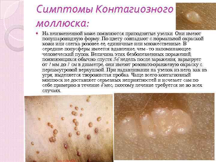 Симптомы Контагиозного моллюска: На неизмененной коже появляются приподнятые узелки. Они имеют полушаровидную форму. По