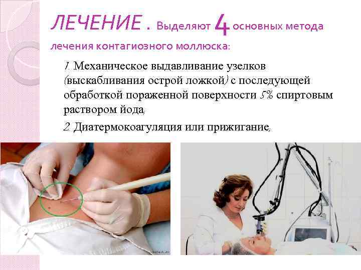 ЛЕЧЕНИЕ. Выделяют 4 основных метода лечения контагиозного моллюска: 1. Механическое выдавливание узелков (выскабливания острой