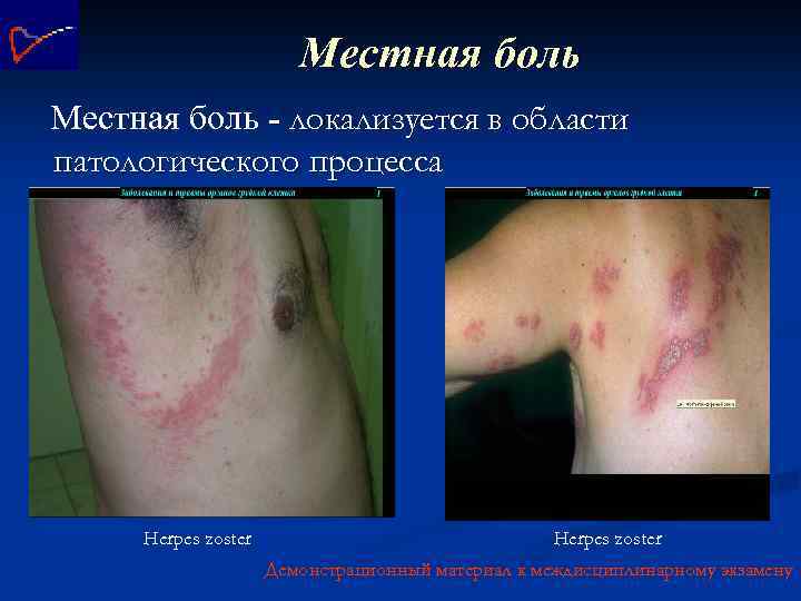 Местная боль - локализуется в области патологического процесса Herpes zoster Демонстрационный материал к междисциплинарному
