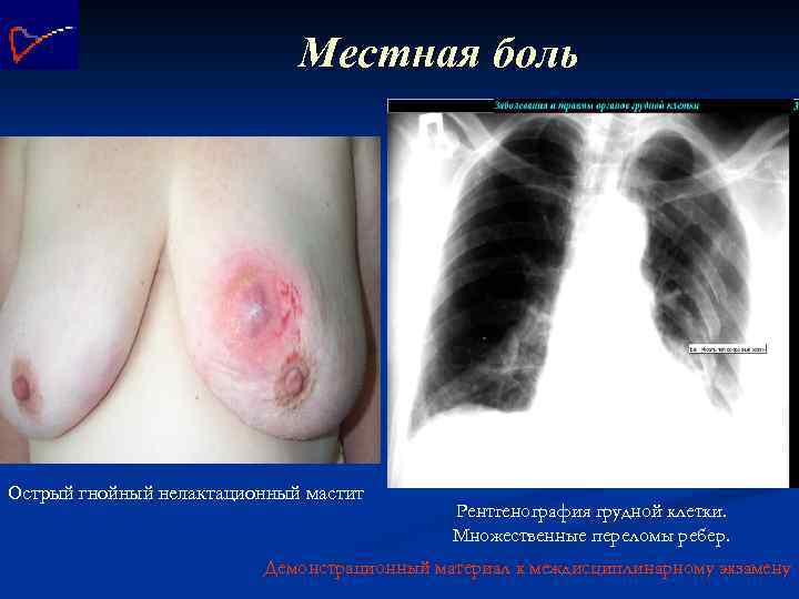 Местная боль Острый гнойный нелактационный мастит Рентгенография грудной клетки. Множественные переломы ребер. Демонстрационный материал