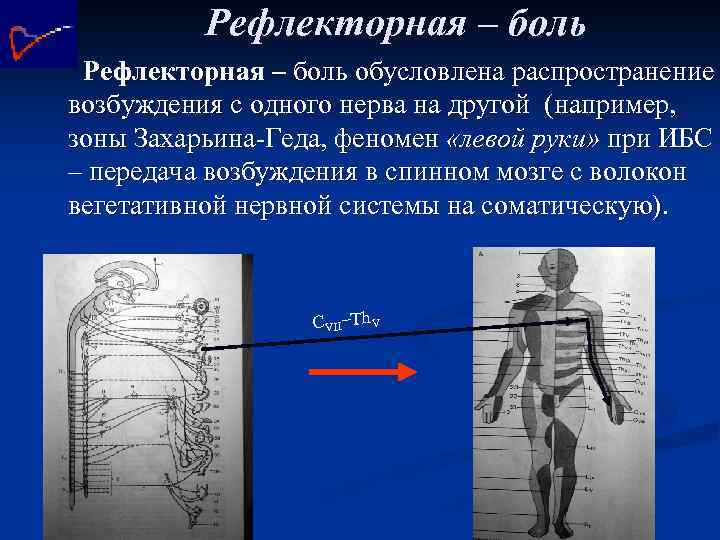 Рефлекторная – боль обусловлена распространение возбуждения с одного нерва на другой (например, зоны Захарьина-Геда,