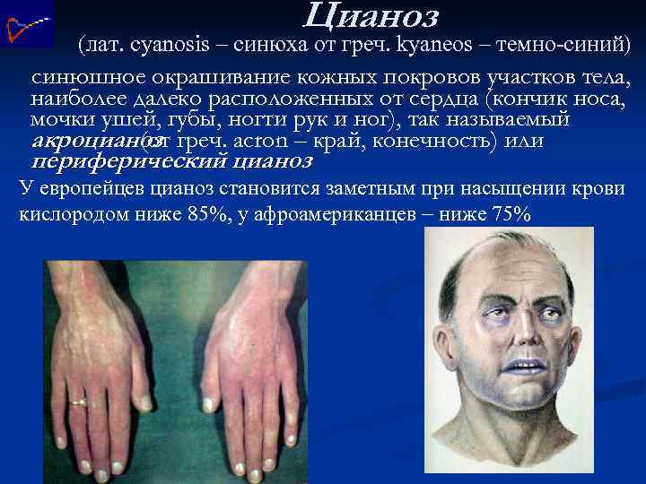Цианоз (лат. cyanosis – синюха от греч. kyaneos – темно-синий) синюшное окрашивание кожных покровов