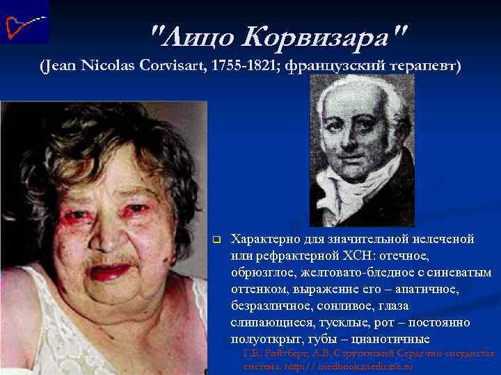 "Лицо Корвизара" (Jean Nicolas Corvisart, 1755 -1821; французский терапевт) q Характерно для значительной нелеченой