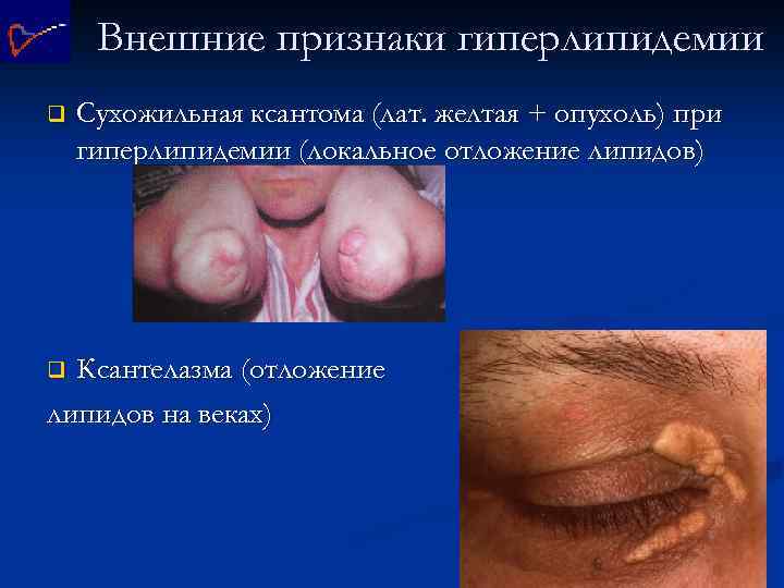 Внешние признаки гиперлипидемии q Сухожильная ксантома (лат. желтая + опухоль) при гиперлипидемии (локальное отложение