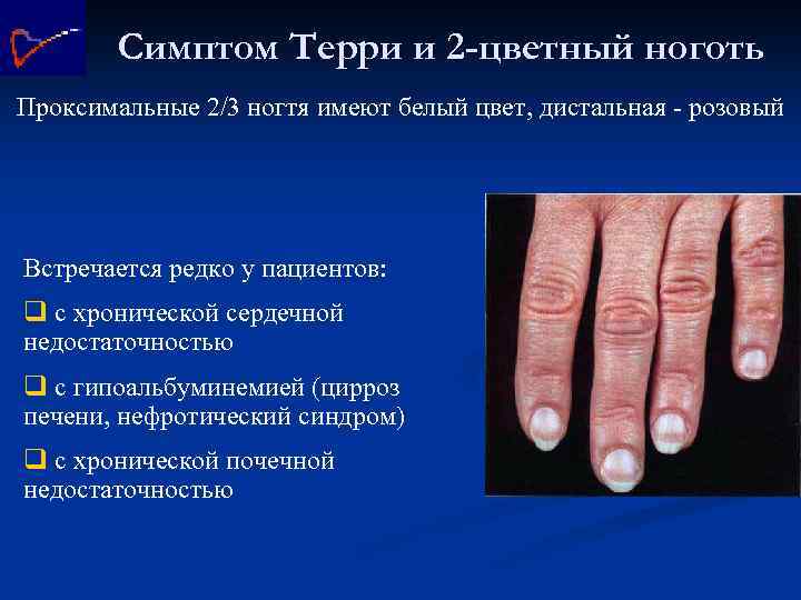 Симптом Терри и 2 -цветный ноготь Проксимальные 2/3 ногтя имеют белый цвет, дистальная -