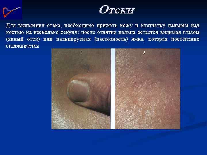 Отеки Для выявления отека, необходимо прижать кожу и клетчатку пальцем над костью на несколько