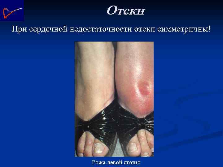 Отеки При сердечной недостаточности отеки симметричны! Рожа левой стопы 