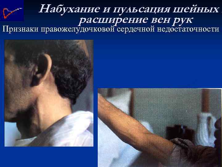 Набухание и пульсация шейных в расширение вен рук Признаки правожелудочковой сердечной недостаточности 