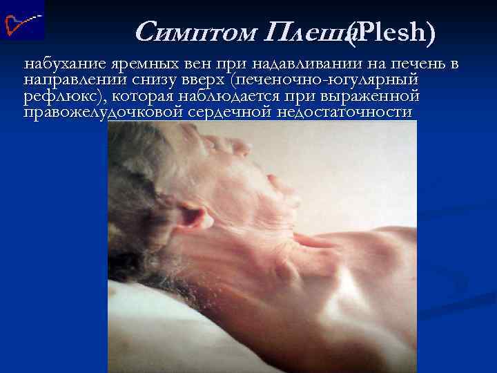 Симптом Плеша (Plesh) набухание яремных вен при надавливании на печень в направлении снизу вверх
