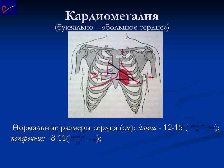 Кардиомегалия (буквально – «большое сердце» ) Нормальные размеры сердца (см): длина - 12 -15