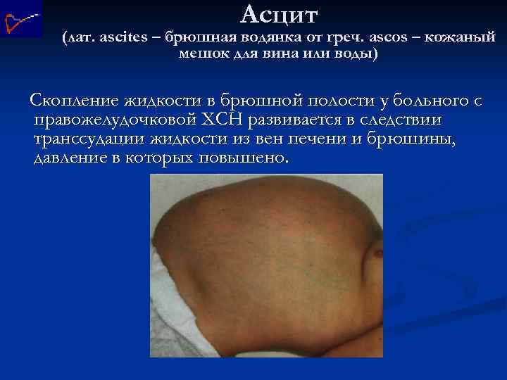 Асцит (лат. ascites – брюшная водянка от греч. ascos – кожаный мешок для вина