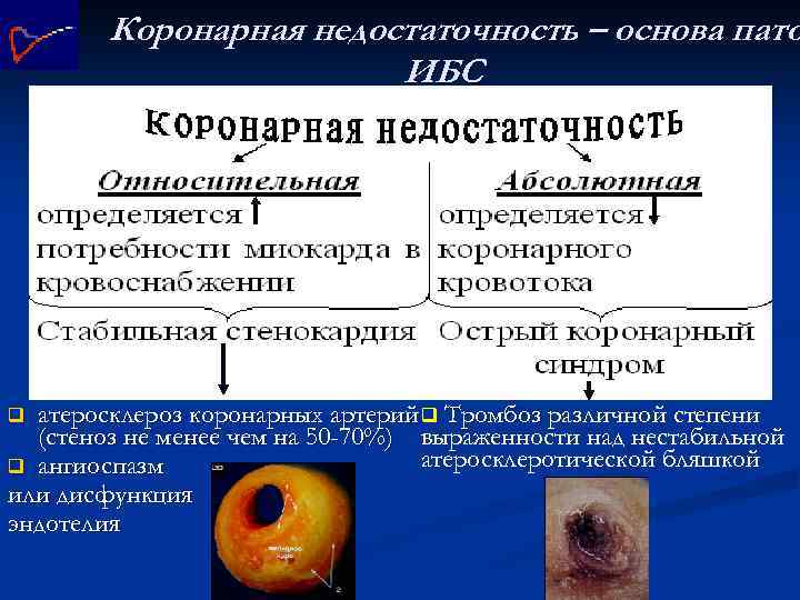 Коронарная недостаточность – основа пато ИБС атеросклероз коронарных артерий q Тромбоз различной степени (стеноз