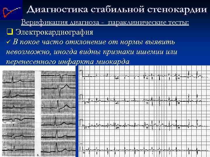 Диагностика стабильной стенокардии Верификация диагноза - параклинические тесты: q Электрокардиография ü В покое часто