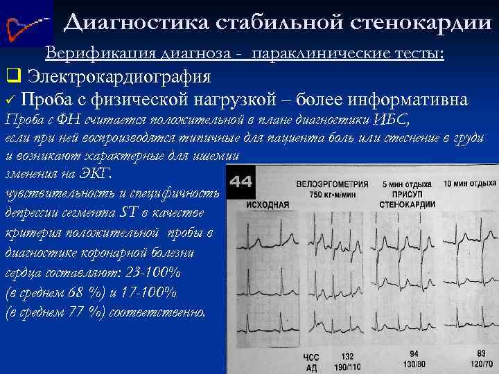 Диагностика стабильной стенокардии Верификация диагноза - параклинические тесты: q Электрокардиография ü Проба с физической