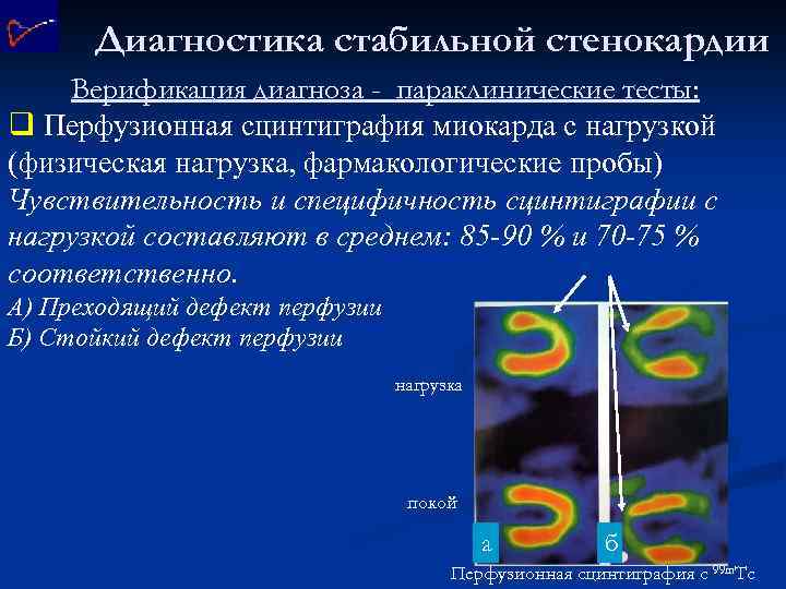 Диагностика стабильной стенокардии Верификация диагноза - параклинические тесты: q Перфузионная сцинтиграфия миокарда с нагрузкой