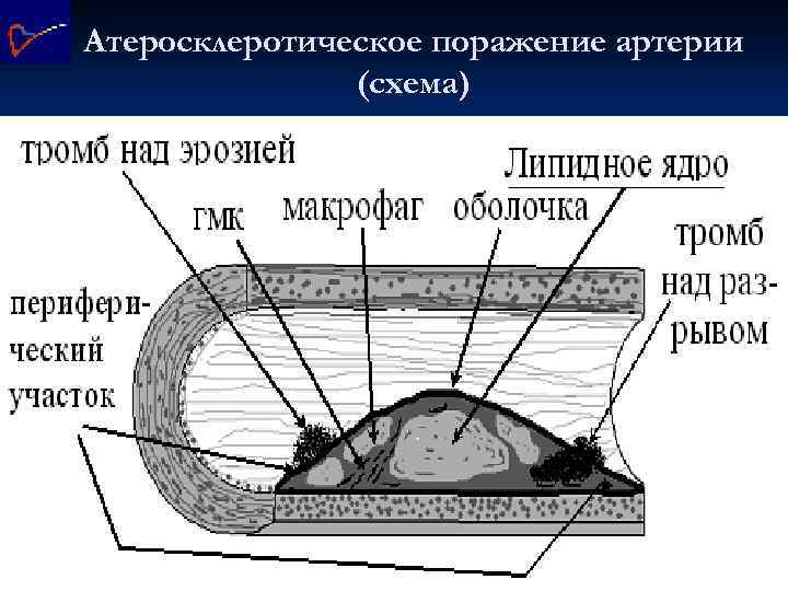 Атеросклеротическое поражение артерии (схема) 