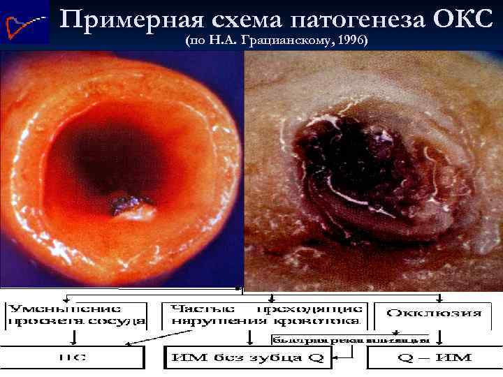 Примерная схема патогенеза ОКС (по Н. А. Грацианскому, 1996) 