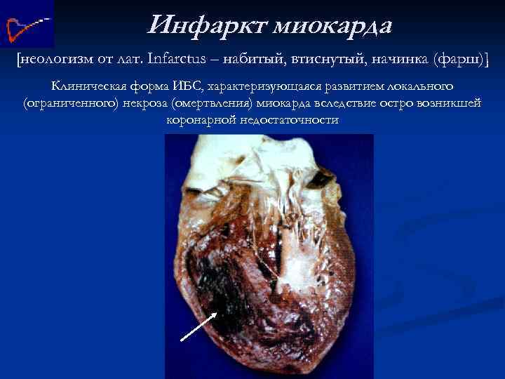 Инфаркт миокарда [неологизм от лат. Infarctus – набитый, втиснутый, начинка (фарш)] Клиническая форма ИБС,