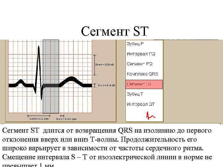 Сегмент ST длится от возвращения QRS на изолинию до первого отклонения вверх или вниз