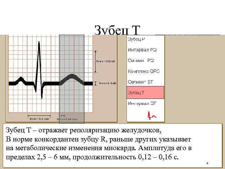 Зубец Т – отражает реполяризацию желудочков, В норме конкордантен зубцу R, раньше других указывает