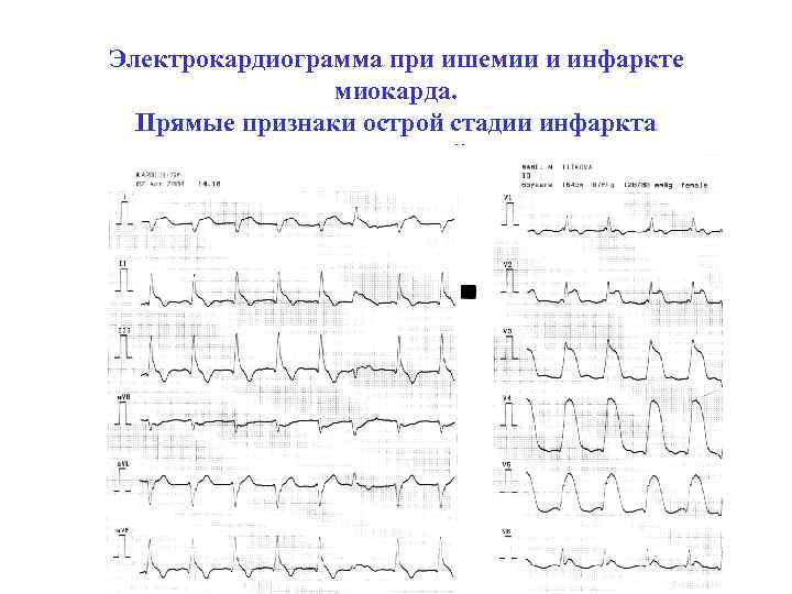 Электрокардиограмма при ишемии и инфаркте миокарда. Прямые признаки острой стадии инфаркта миокарда передней стенки