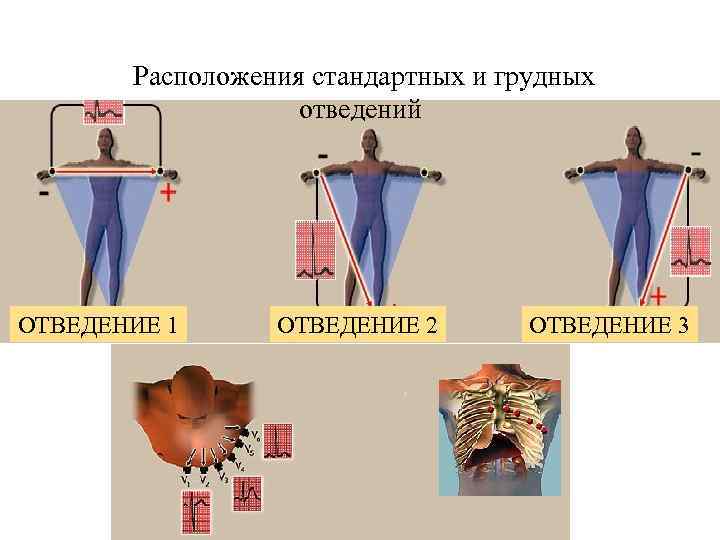 Расположения стандартных и грудных отведений ОТВЕДЕНИЕ 1 ОТВЕДЕНИЕ 2 ОТВЕДЕНИЕ 3 