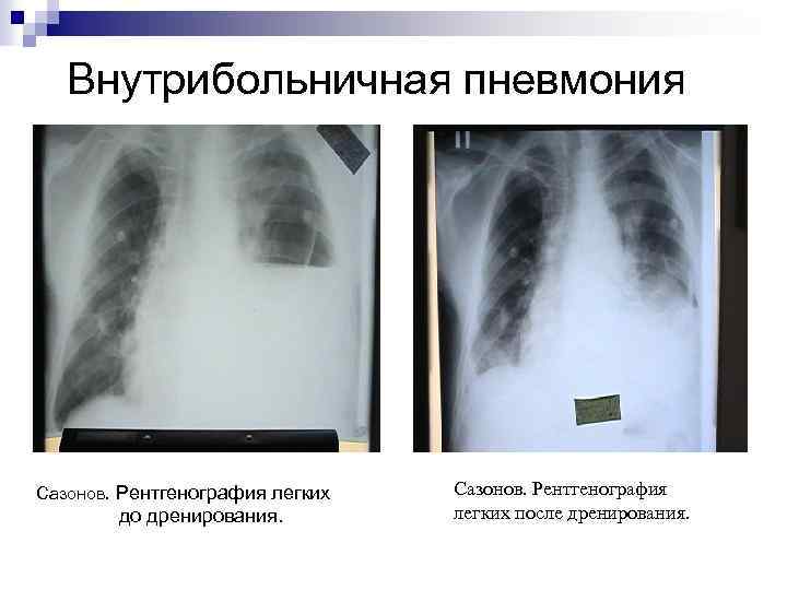 Внутрибольничная пневмония Сазонов. Рентгенография легких до дренирования. Сазонов. Рентгенография легких после дренирования. 